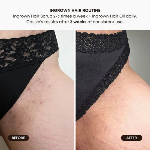 Bushbalm-Ingrown Hair Oil ~ Key Lime Pie