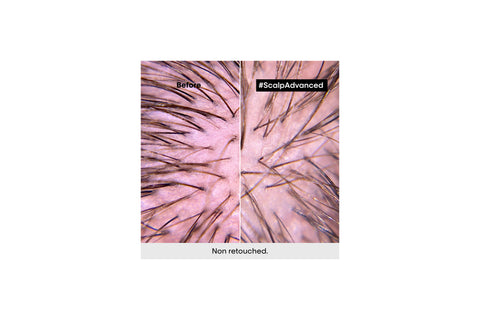 Scalp Advanced | Anti-Discomfort Dermo Regular Shampoo