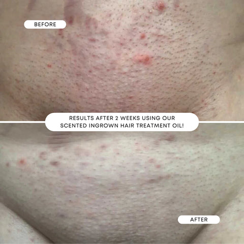 Bushbalm- Ingrown Hair Oil ~ SWEET ESCAPE