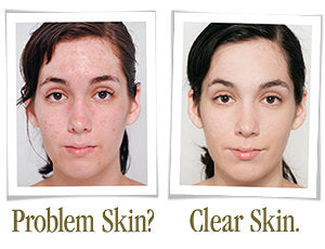 Eminence Clear Skin Starter Set